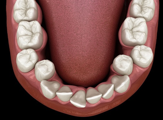 Illustration of crooked teeth