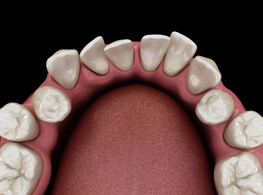 Illustration of gapped teeth