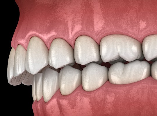 Illustration of an overbite