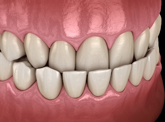 Illustration of an underbite