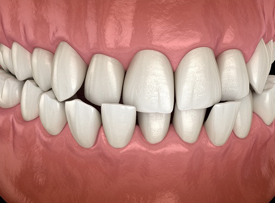 Illustration of a crossbite