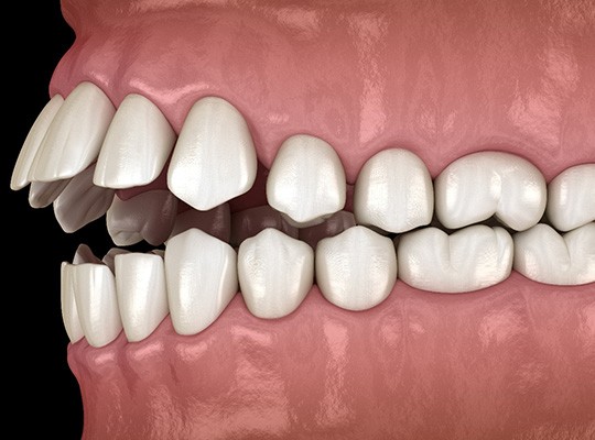 Illustration of an open bite