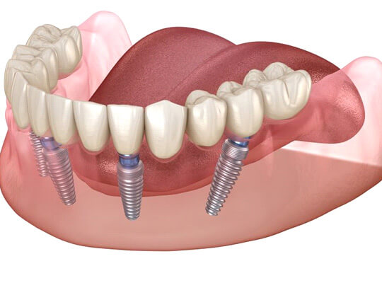 illustration of all-on-4 dental implants against white background