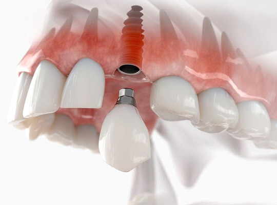 illustration of dental implant in upper dental arch