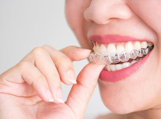 Close up of woman inserting an Invisalign tray