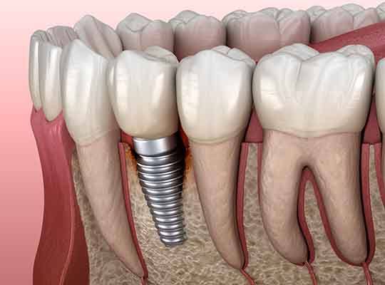 Bone loss around failed dental implant in Parma Heights, OH