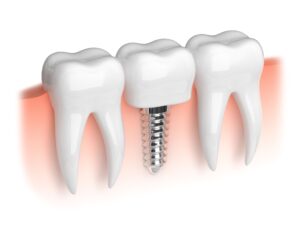 A rendering of a dental implant between 2 teeth